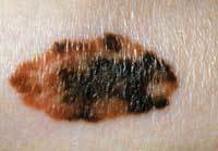 Skin cancer is among the complications of solid organ transplantation. Skin cancer is among the complications of solid organ transplantation.