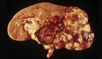 Personalized RCC Treatment May Be Superior