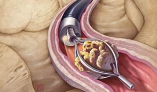 Technological advances have led to increased application of flexible ureteroscopy. Technological advances have led to increased application of flexible ureteroscopy.