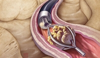 Technological advances have led to increased application of flexible ureteroscopy.