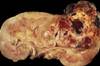Partial Nephrectomy Superior Despite Kidney Tumor Size Partial Nephrectomy Superior Despite Kidney Tumor Size