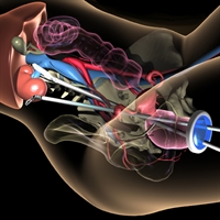 An illustration showing how surgeons performed a transvaginal nephrectomy.