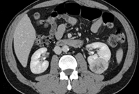 Nephron-sparing surgery may be appropriate for this 5 cm left renal mass.