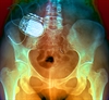 Sacral Neuromodulation Can Ease Refractory Overactive Bladder in the Elderly