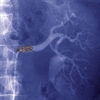 New Method Predicts Stent Responders