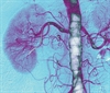 Treating RAS To Stent or Not to Stent
