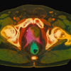 Prostate Cancer Men's Health