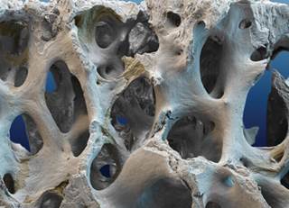 Few studies have looked at osteoporosis therapies in patients with CKD stages 4-5 Few studies have looked at osteoporosis therapies in patients with CKD stages 4-5