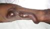 The Pros and Cons of Interventional Nephrology The Pros and Cons of Interventional Nephrology