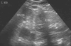 March 2011 Hispanic Woman Admitted With Left Flank Pain