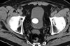 April 2011 Cystolithiasis in a Man With Painless Gross Hematuria