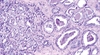Relationships of Testosterone and Prostate Cancer: A 2011 Perspective