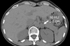 June 2011 Should We Be WashingOut for Adrenal Incidentalomas