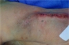 July 2011 Increased Bleeding from Dialysis Access