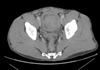 August 2011 With Bladder Tumors, Size Isnt Everything
