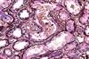 Clinical Quiz: Elderly Man with Anorexia and Acute Renal Failure Clinical Quiz: Elderly Man with Anorexia and Acute Renal Failure