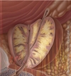 Intermittent ADT in Prostate Cancer: A Step-by-Step Approach