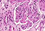 Renal Failure Clusters in Families Renal Failure Clusters in Families