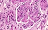 November 2011 Failed Kidney Transplant in a 31YearOld Woman