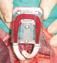 Figure 1. An implantable artificial kidney moves closer to reality.