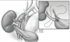 Renal ATPV for Intractable Stone Disease