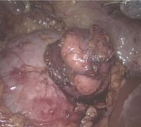 An Update on Robotic-Assisted Partial Nephrectomy
