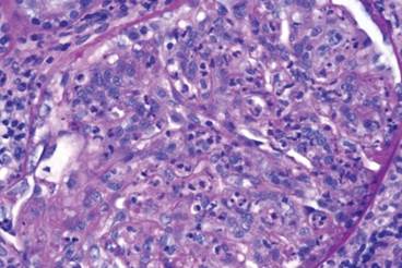 Applying Precision Medicine to Systemic Lupus Erythematosus Applying Precision Medicine to Systemic Lupus Erythematosus