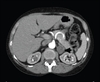 Unusual Manifestation of an AldosteroneProducing Adenoma
