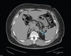 Resistant Hypertension Secondary to Primary Aldosteronism