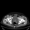 March 2012 HighGrade Urothelial Carcinoma Invading Lamina Propria
