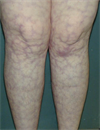 April 2012 66YearOld Woman with AcuteonChronic Renal Failure and Skin Rash