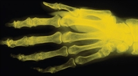 Managing Bone Disease in Kidney Transplant Recipients