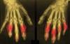 Homocysteine Levels Elevated in Gout Patients Homocysteine Levels Elevated in Gout Patients