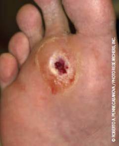 Active foot ulcers portend bad outcomes for diabetic dialysis patients. Active foot ulcers portend bad outcomes for diabetic dialysis patients.