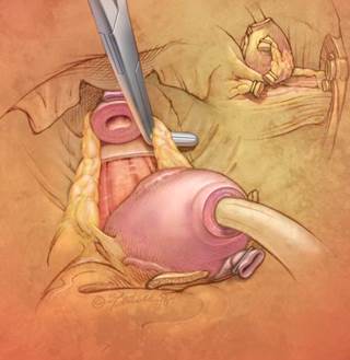 Nerve-Sparing Prostate Surgery May Raise PSM Risk Nerve-Sparing Prostate Surgery May Raise PSM Risk