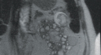 The Association Between Kidney Failure and Renal Cell Carcinoma