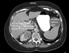 Approaches to Renal Surgery in the Frail Elderly