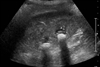 Lower Right Abdominal Pain in a Kidney Transplant Recipient
