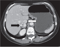 Thyroid Functional Disease
in Dialysis Patients