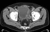 The Sin of Omission in Patients Undergoing Radical Cystectomy? The Sin of Omission in Patients Undergoing Radical Cystectomy?