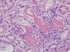 Acute Kidney Injury and Plasma Cell Dyscrasia Acute Kidney Injury and Plasma Cell Dyscrasia