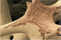 Managing Bone Loss Associated with Androgen Deprivation Therapy
