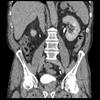 Quantifying Risk of Perioperative Death Following Cystectomy in the Elderly Quantifying Risk of Perioperative Death Following Cystectomy in the Elderly