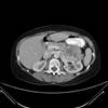 The Role of Surgery in Patients with Metastatic RCC The Role of Surgery in Patients with Metastatic RCC