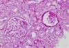 A Case of Massive Proteinuria A Case of Massive Proteinuria