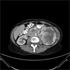 Choice of First-Line Targeted Therapy Agent for Metastatic Clear Cell RCC Choice of First-Line Targeted Therapy Agent for Metastatic Clear Cell RCC