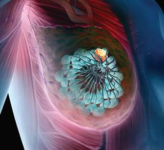 Higher breast cancer death risk linked to low eGFR. Higher breast cancer death risk linked to low eGFR.