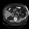 Adrenal Mass in a Patient with High-Risk RCC Adrenal Mass in a Patient with High-Risk RCC