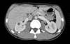A Case of Hematuria and Flank Pain A Case of Hematuria and Flank Pain