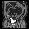 Long-Term Renal Function Following Urinary Diversion Long-Term Renal Function Following Urinary Diversion